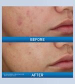 CeraVe Acne Foaming Cream Wash 150g